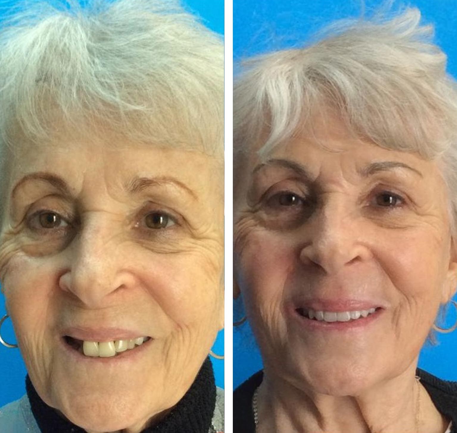 before and after collage photo of woman with All On X