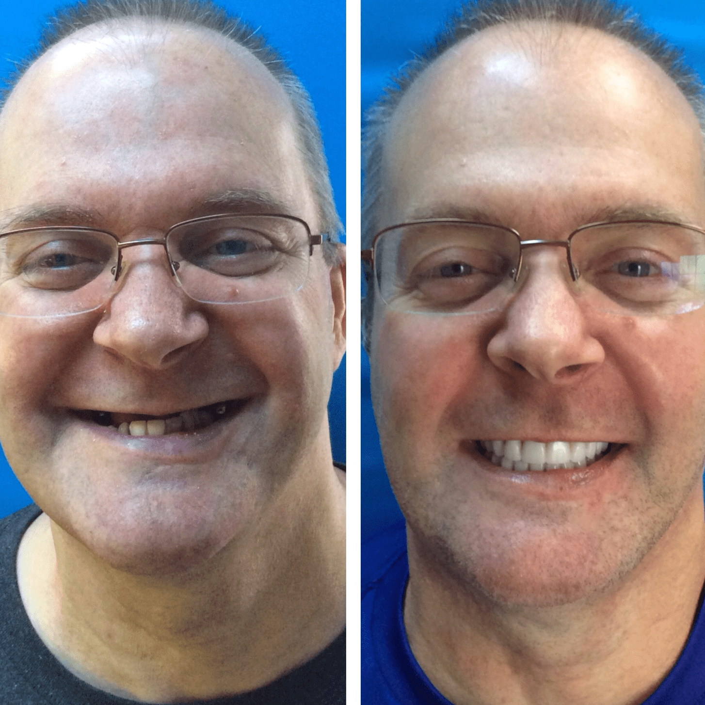 before and after collage of male with AOX Upper and Lower