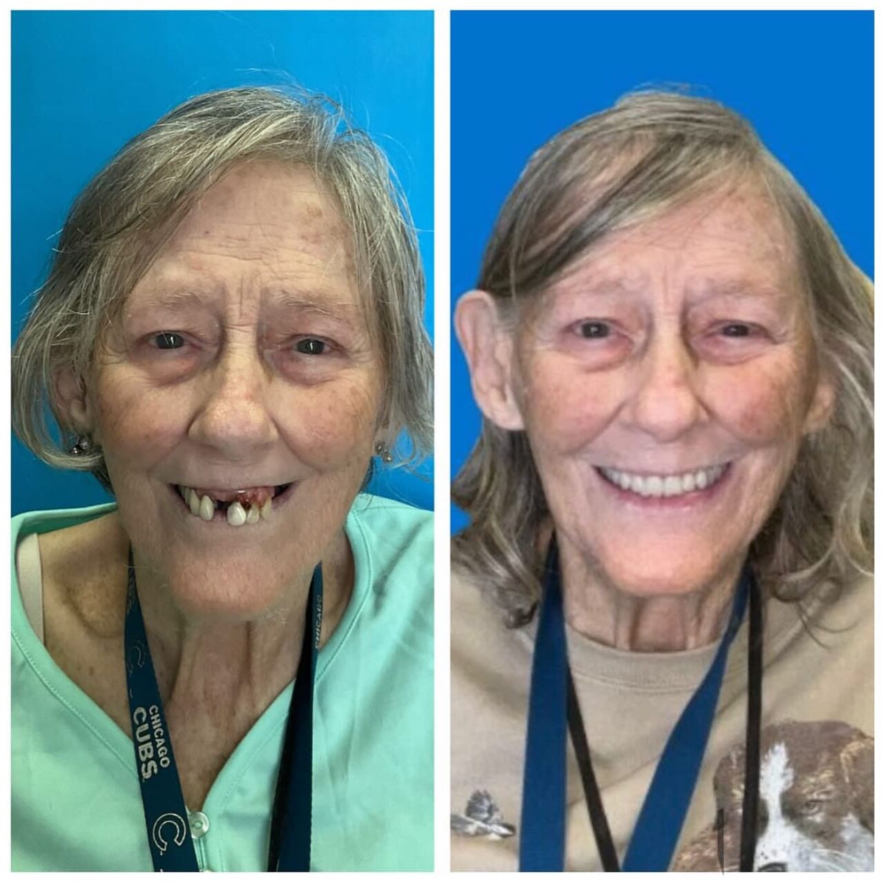 before and after collage photo of woman with upper complete denture, lower overdenture