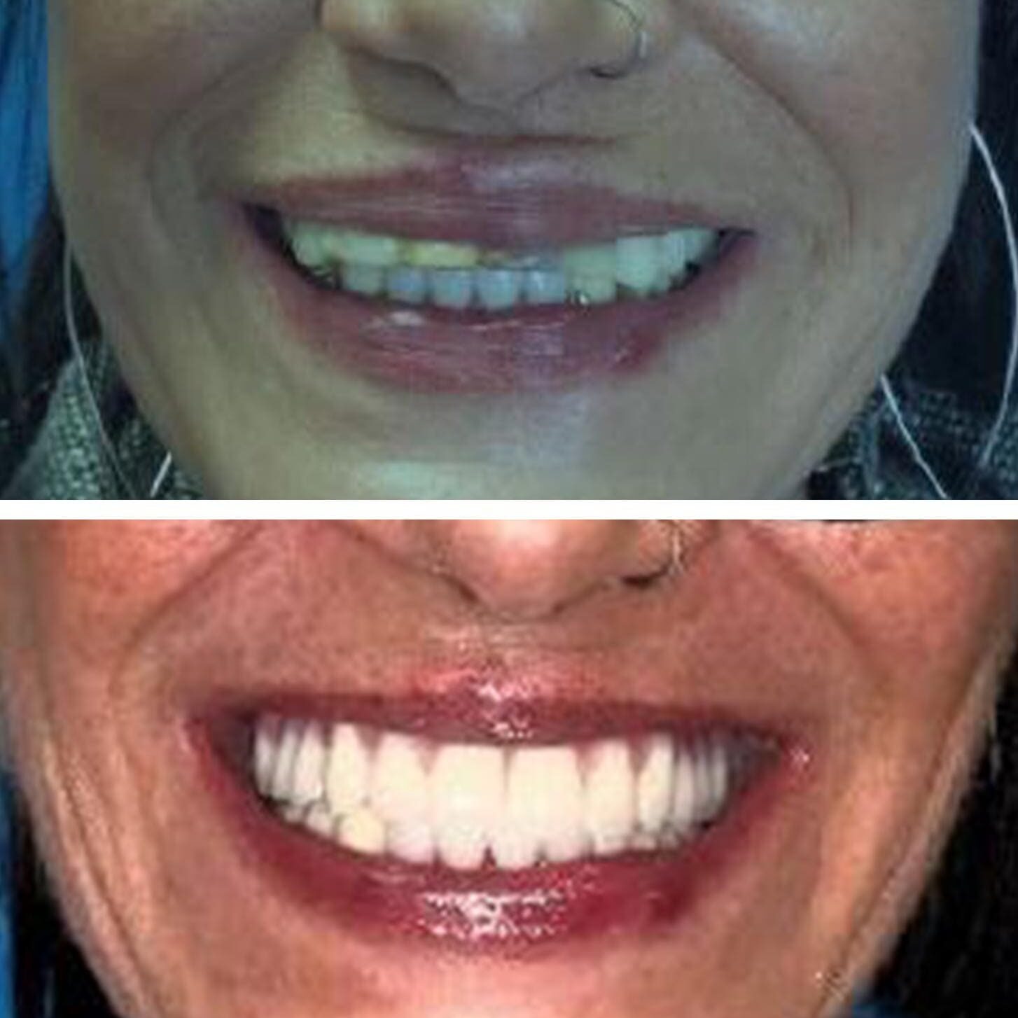 before and after collage of female with Upper All On X
