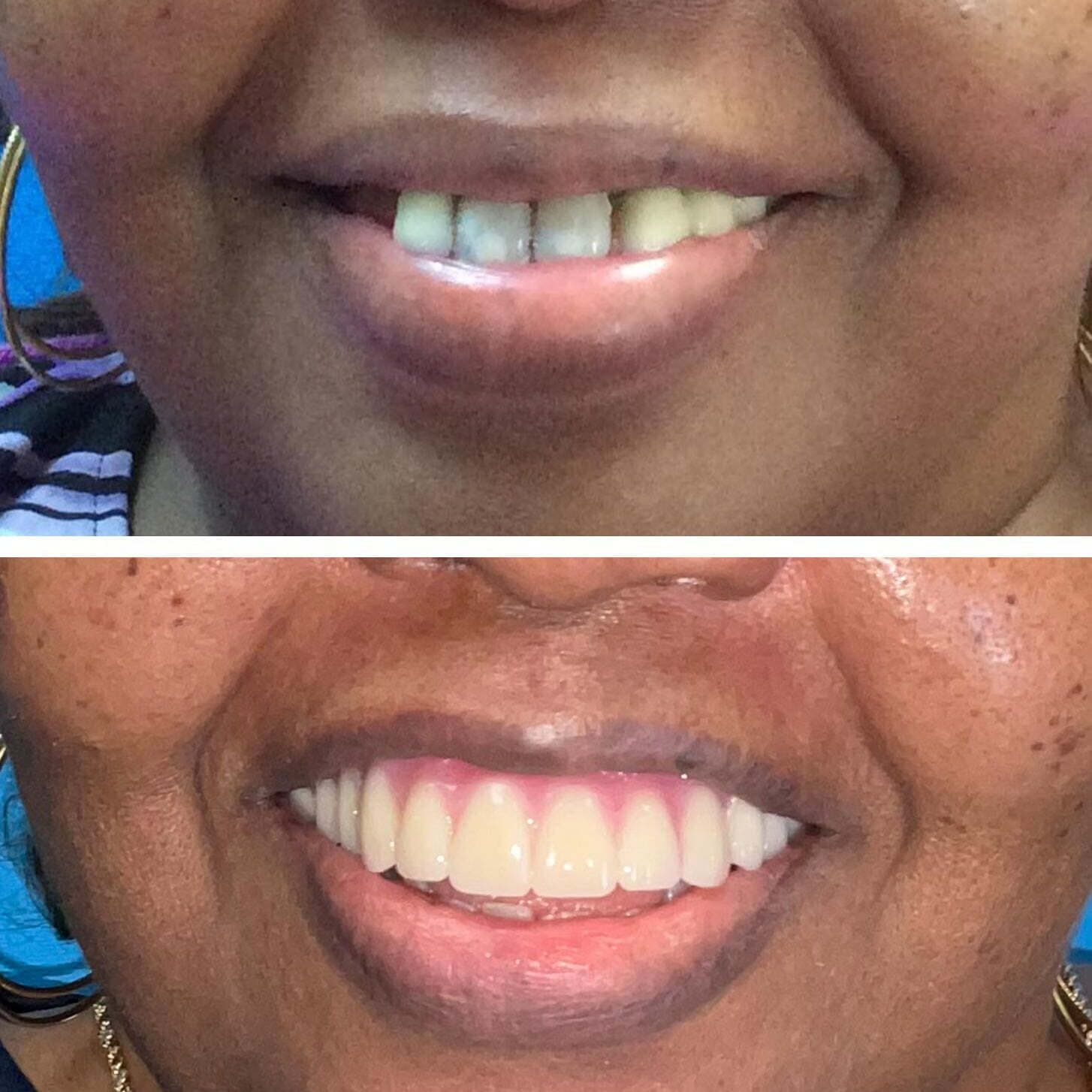 before and after collage of female with Upper All On X