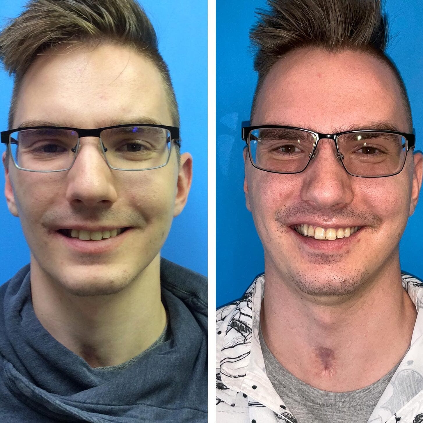 before and after collage of male with Implant Crown