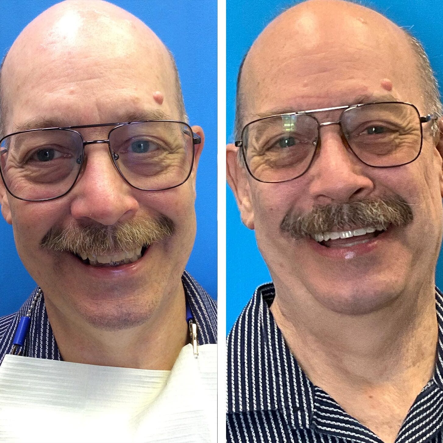 before and after collage of male with Upper And Lower All On X