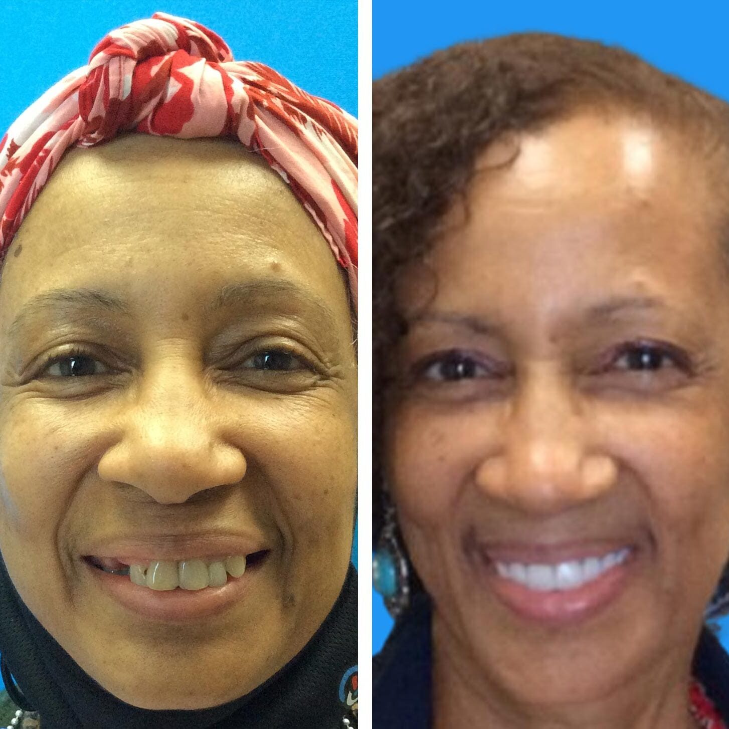 before and after collage of female with Upper All On X
