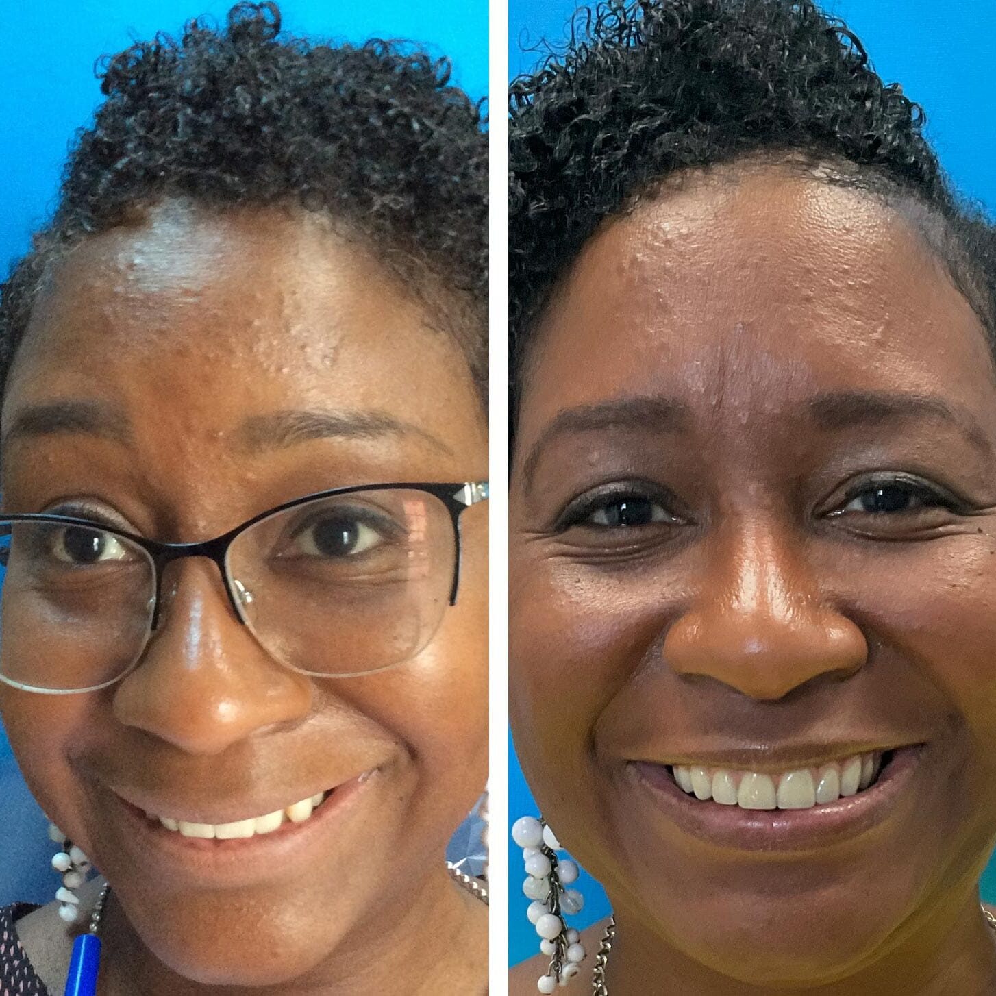 before and after collage of female with Upper All On X