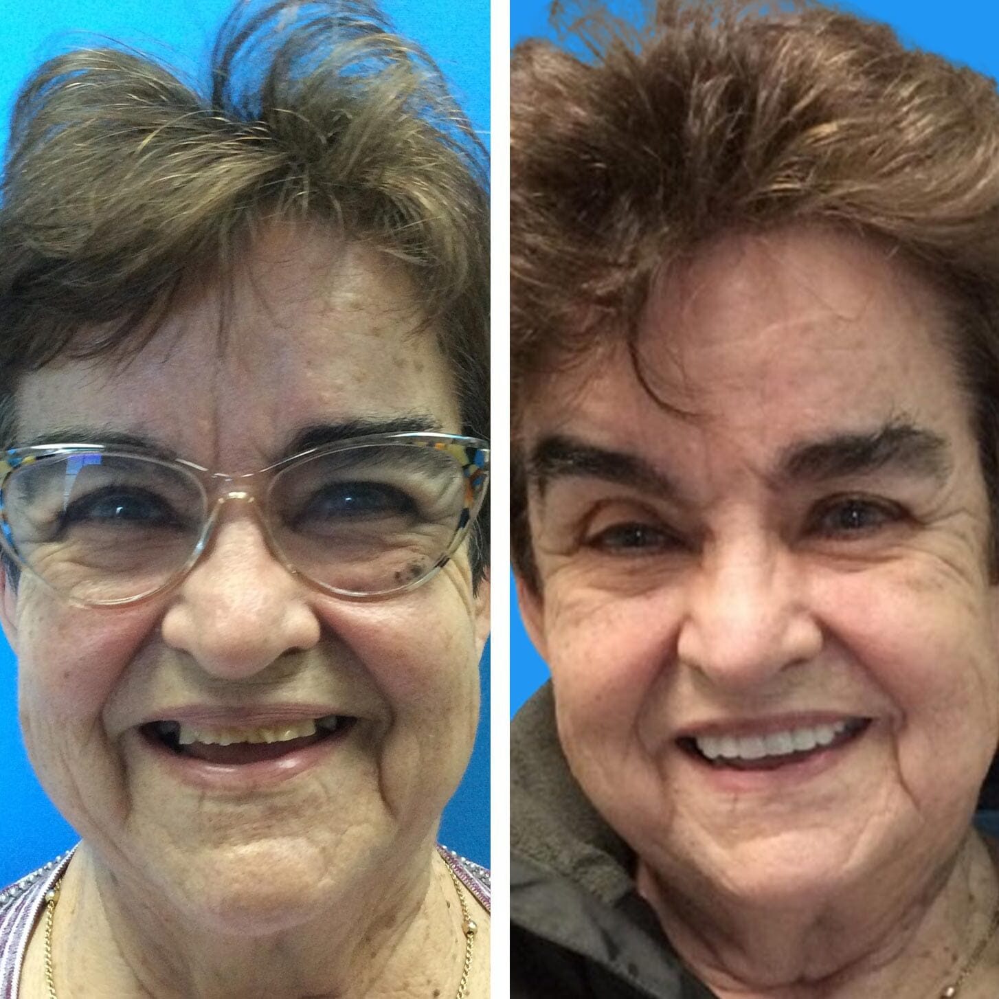 before and after collage of female with Upper Crown And Partial Denture