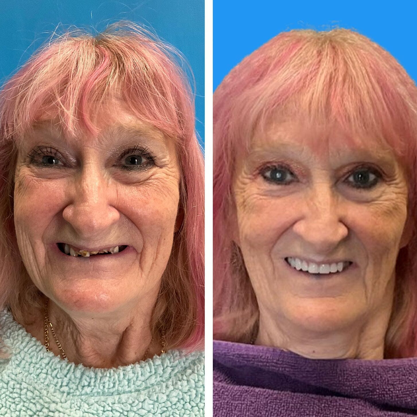 before and after collage of female with Upper Crown Partial Denture Lower Overdenture