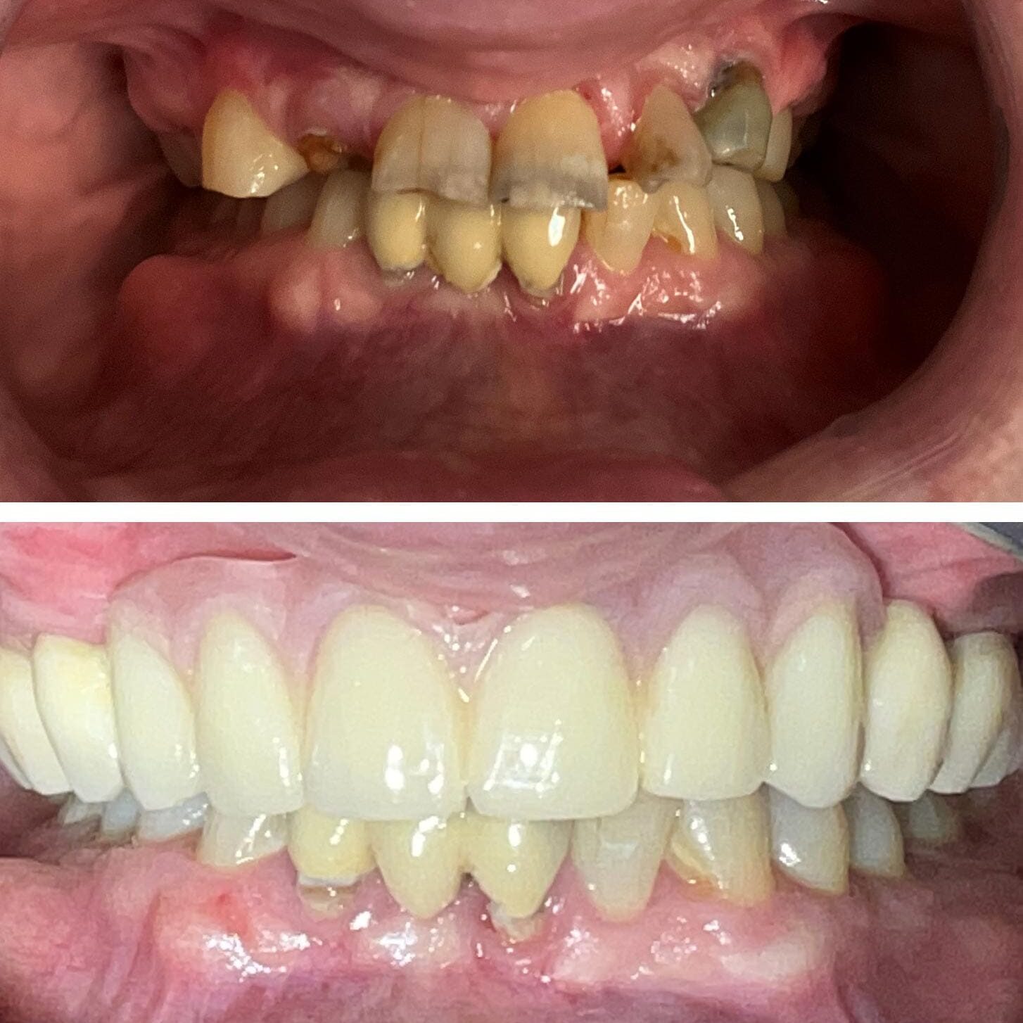 before and after collage of Upper Partial Denture And Lower Fillings